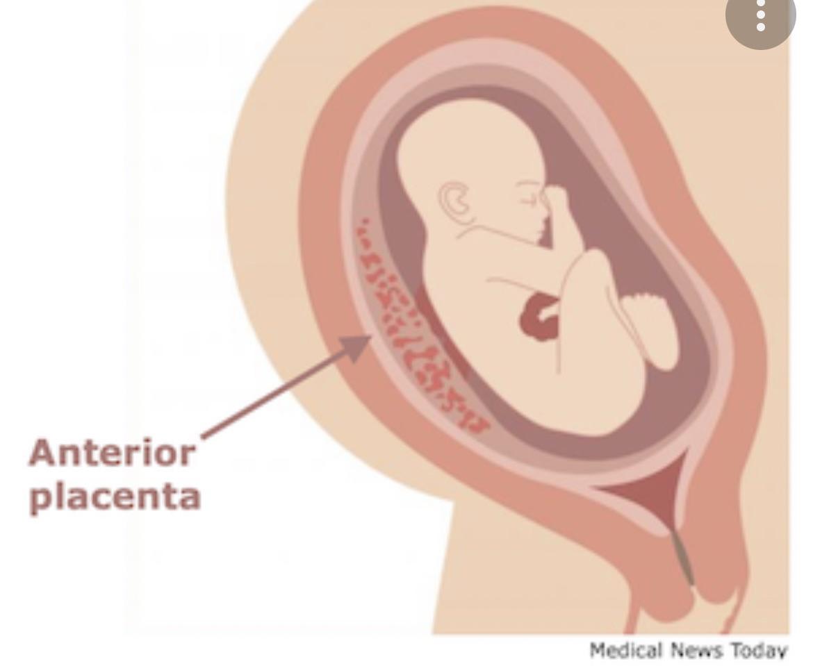 Anterior placenta mommas