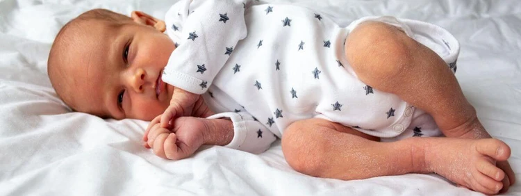 Newborn Dry Skin: What to Know and What to Do