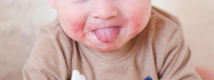 Teething Rash: Symptoms, Tips, and Advice