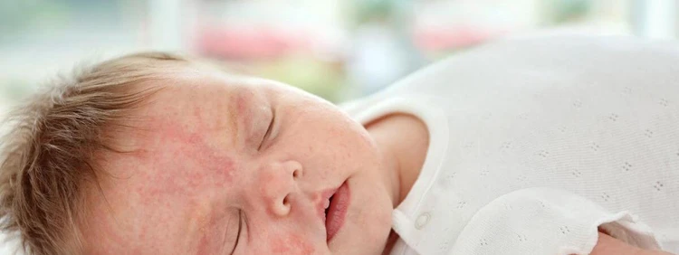 What is an Angel's Kiss Birthmark?